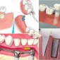 What is Prosthetic Dental Treatment?